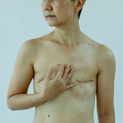 post cancer breast surgeries